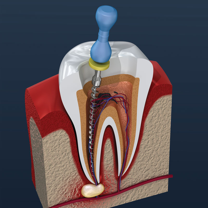 endodoncia
