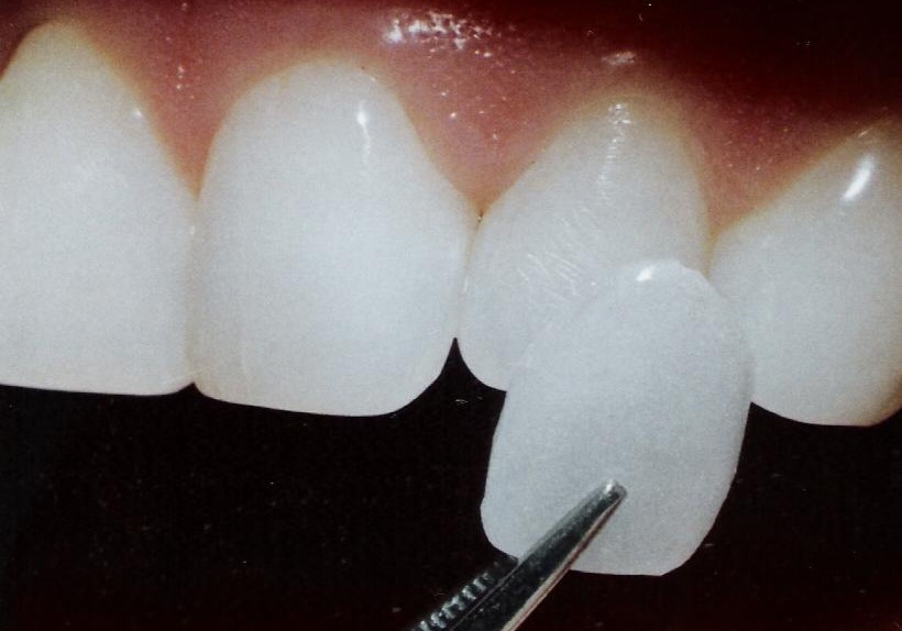 Carillas de Porcelana